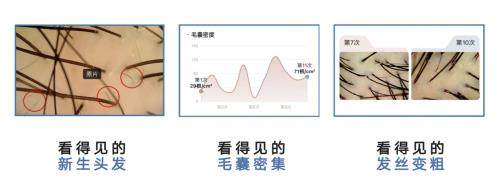 Get超院线级防脱养发实力 看得见效果的MYAI密发仪Bandao体育半岛(图8)
